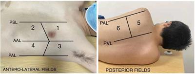 Randomized controlled trial of ultra-protective vs. protective ventilation strategy in veno-arterial extracorporeal membrane oxygenation patients with refractory cardiogenic shock: a study protocol for the ultra-ECMO trial